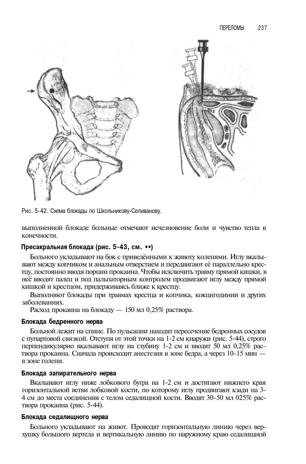 Блокада при кокцигодинии техника. Пресакральная новокаиновая блокада. Методика блокады при кокцигодинии. Новокаиновая блокада по Школьникову Селиванову травматология. Школьникова селиванова