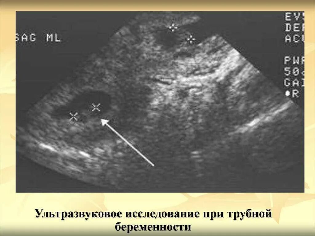 Внематочная Трубная беременность УЗИ. Ультразвуковое исследование беременности на ранних сроках. Внематочная беременность в трубе УЗИ. УЗИ внематочной беременности на раннем сроке. На узи видно внематочную