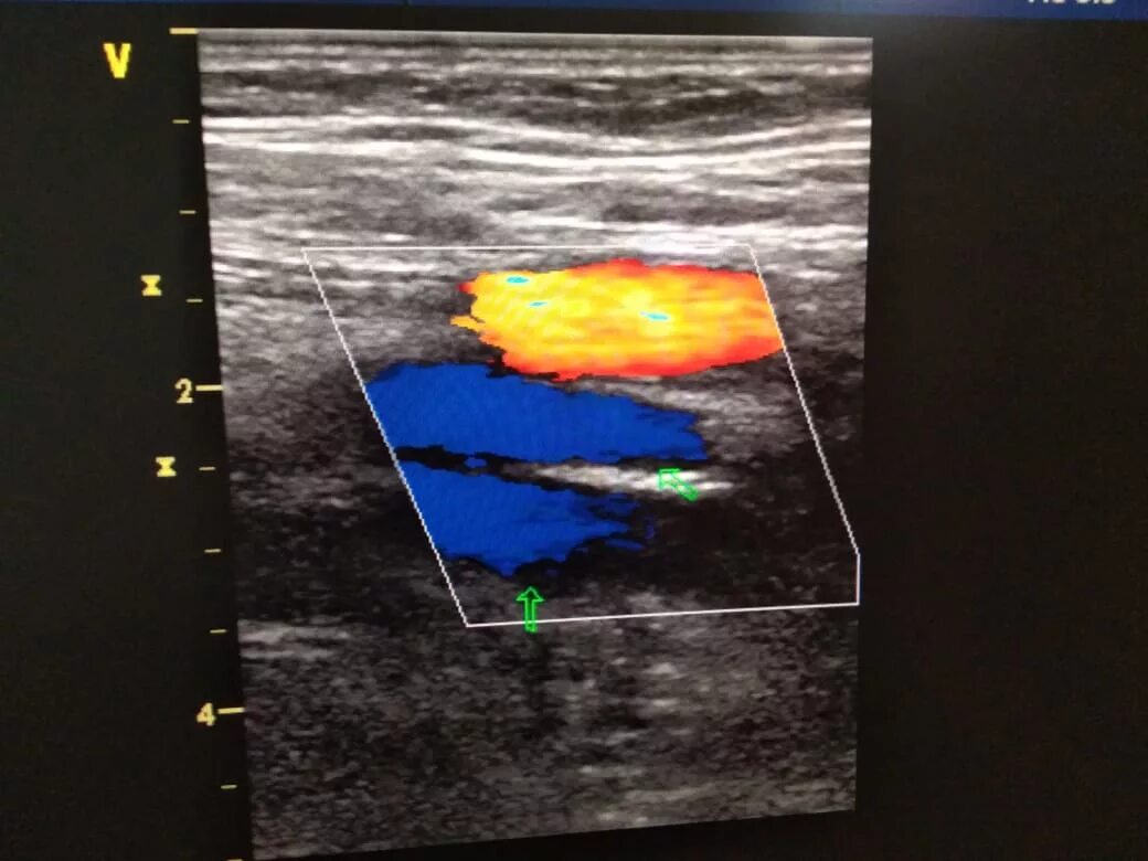 Как называется узи вен. УЗДГ вен нижних конечностей при тромбозе. Варикозное расширение вен УЗИ. Ультразвуковая допплерография нижних конечностей.
