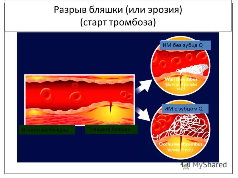 Разрыв бляшки