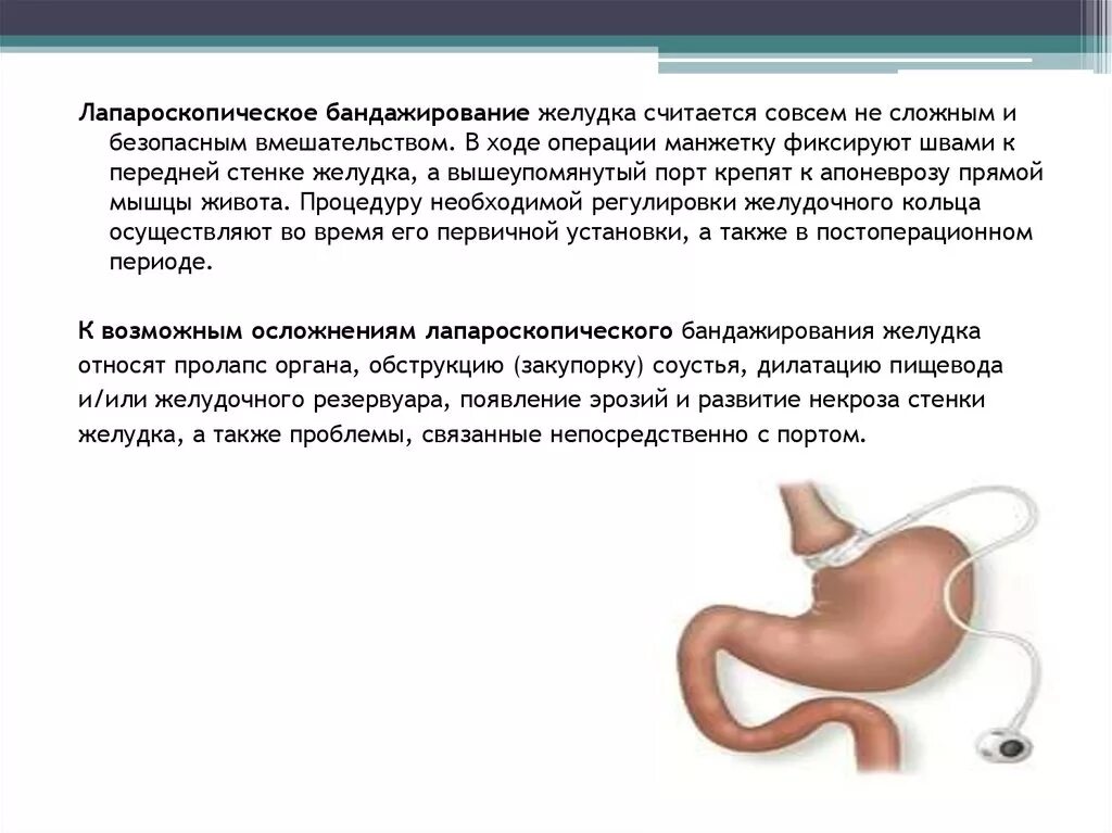 Последствия операции желудка. Бандажирование желудка ход операции. Бандажирование желудка осложнения. Бариатрическая операция бандажирование желудка. Лапароскопическое регулируемое бандажирование желудка.