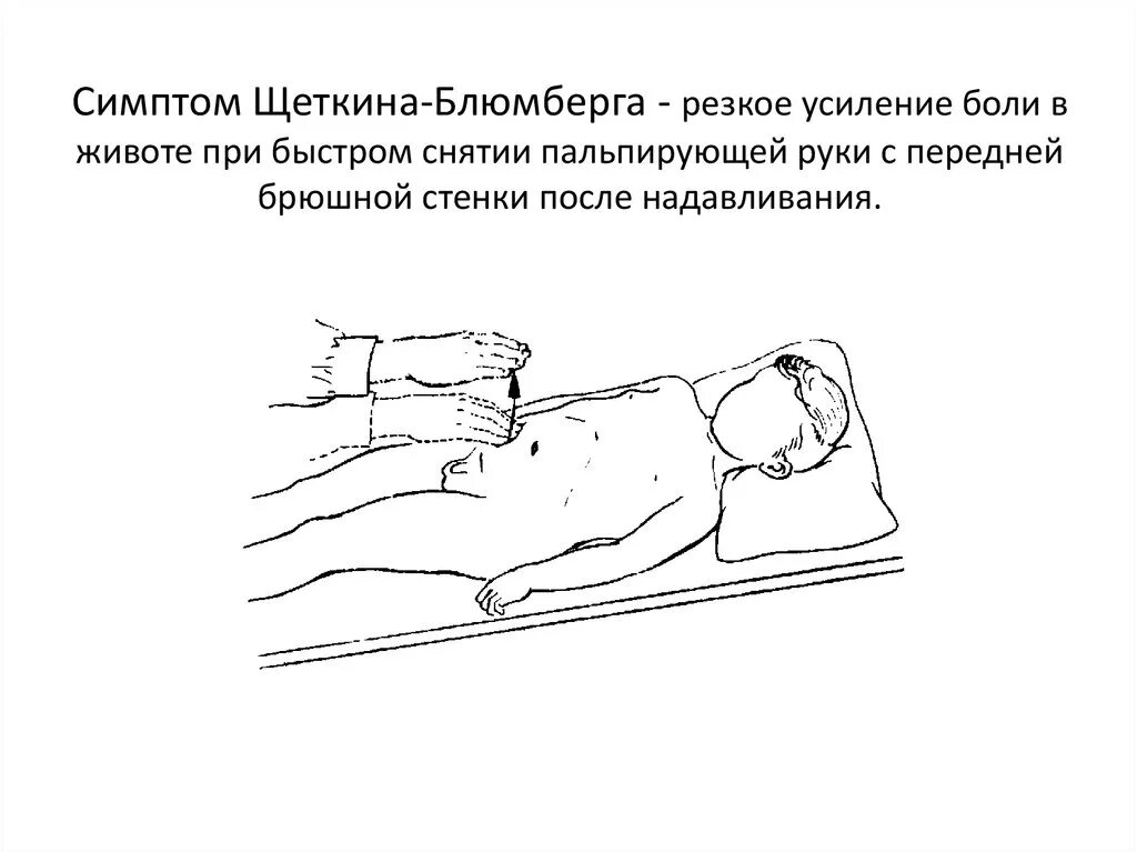 Пальпация при остром животе. Методика выполнения симптома Щеткина Блюмберга. Положительный симптом Щёткина-Блюмберга. Синдром Щеткина -Блюмберга это. Симптом Щеткина Блюмберга это признак.