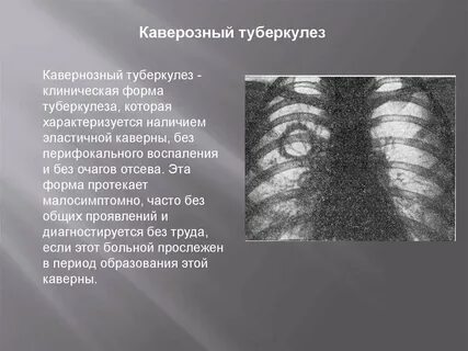 Течение кавернозного туберкулеза