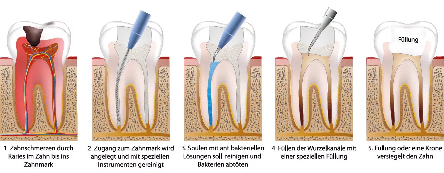 Пульпит зуба гуттаперча. Зубной штифт после пульпита. Пульпит корневого канала. Временное пломбирование корневых