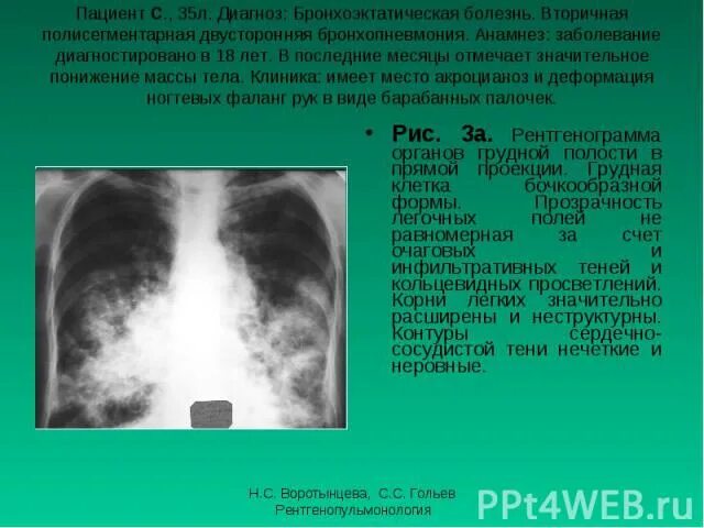 Без очаговых и инфильтративных изменений. Очаговые и инфильтративные тени. Легочные поля без очаговых и инфильтративных изменений. Очаговая тень в проекции легких. Лёгочные поля без очаговых и инфильтративных теней.