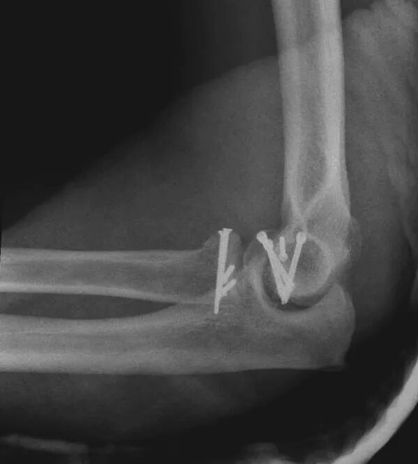 Перелом с захождением отломков по длине. Типы смещения отломков при переломах. Смещение отломков с вклинением. Захождение отломков по длине. Перелом со смещением по длине.