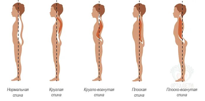 Главной причиной нарушения осанки является слабость мышц. Тип осанки кругловогнутая спина. лордоз кифоз сколиоз у детей. плосковогнутая спина у детей. лордоз кифоз и сколиоз дошкольника.