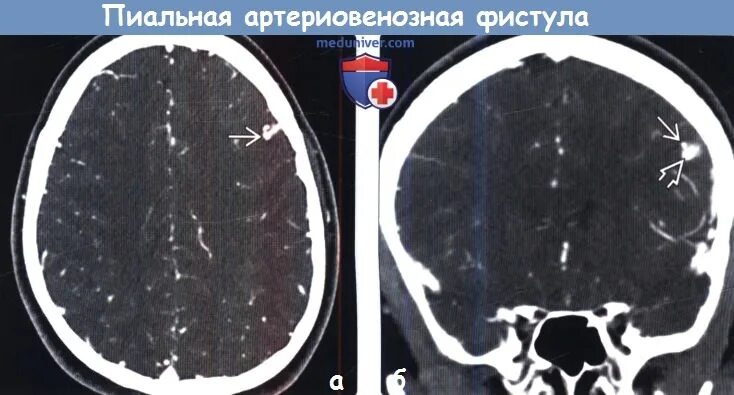 Дуральный артериовенозная фистула. Артериовенозная фистула в головном мозге. Артериовенозная фистула мрт. Мальформация на кт головного мозга. Артерио-венозная фистула мрт.
