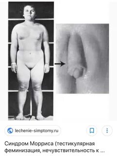 Slideshow down syndrome dick pic.