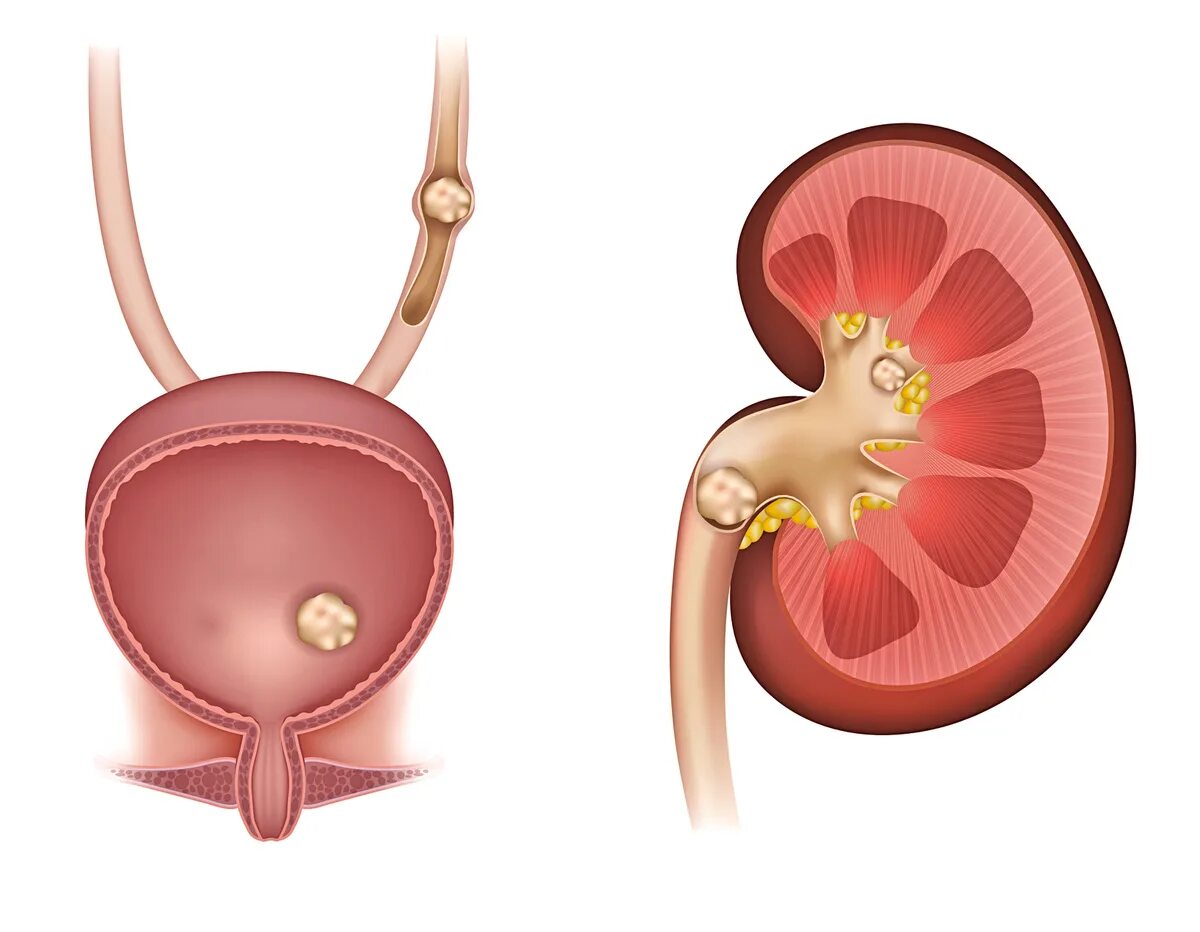 Мочевая колика. Мочекаменная болезнь камни в почках. Мочекаменная болезнь в мочевом пузыре. Мочекаменная болезнь. Обструкция мочеточника. Мочекаменная и Почечнокаменная болезнь.