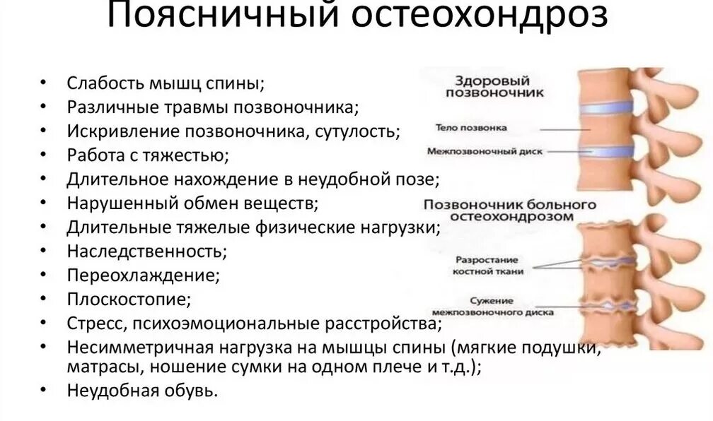 Остеохондроз поясничного отдела периоды. Остеохондроз поясничном отделе позвоночника схема. Поясничный остеохондроз симптомы и лечение. Остеохондроз поясничного отдела симптомы.