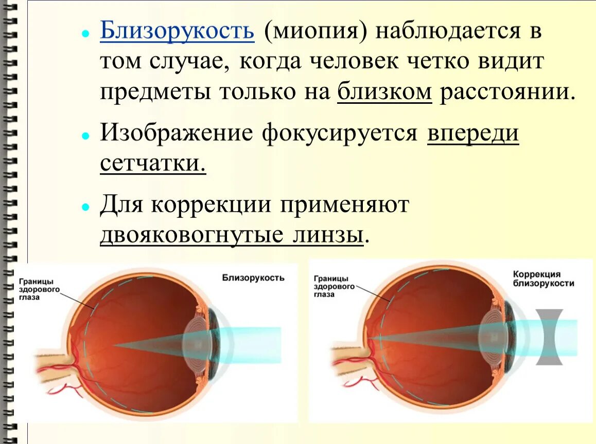 Какое изображение появляется на сетчатке глаза. Близорукость (истинная и ложная формы патологии). Миопия. Заболевание глаз миопия. Заболевания глаз близорукость.