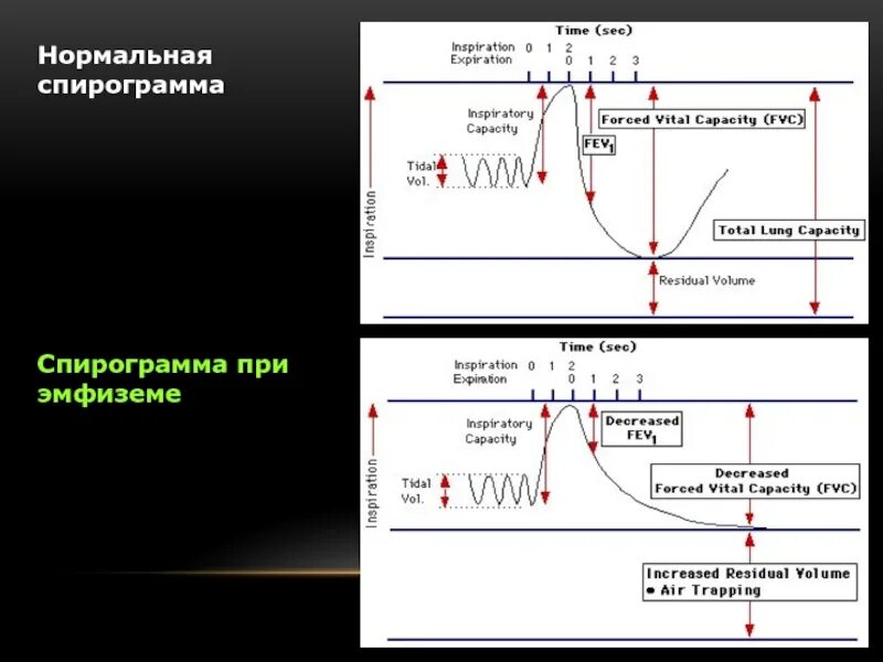 Что показывает спирограмма легких. Спирограмма обструктивный тип. обструкция и рестрикция на спирограмме. спирограмма типы нарушений. спирограмма астматика.