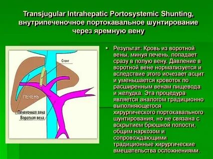 Синдром шунтирования печени