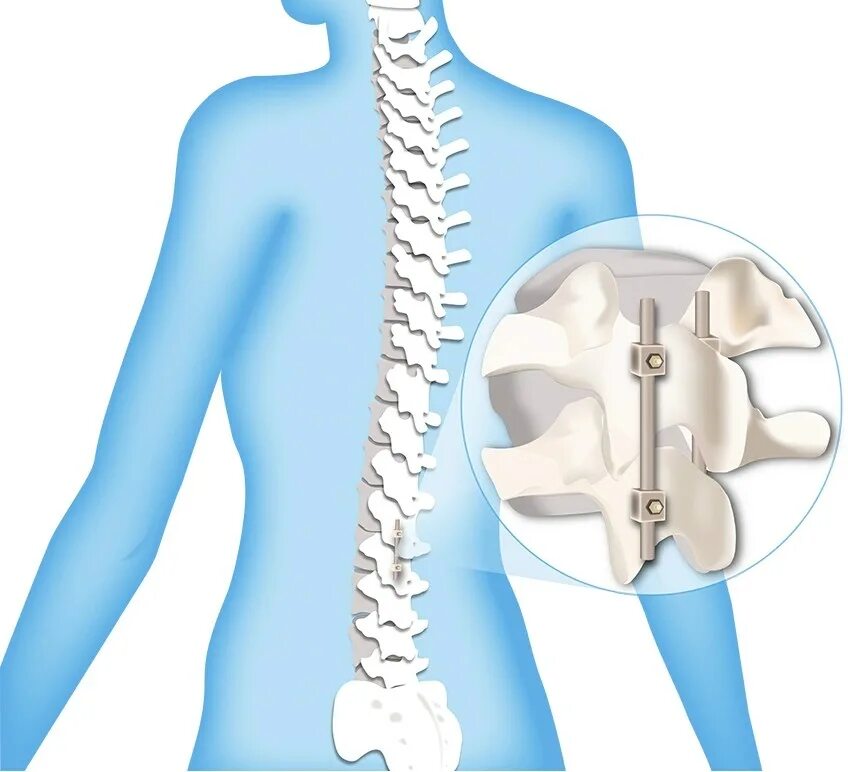 Фиксаторы позвоночника Stryker Spine. Нейрохирургия позвоночника.