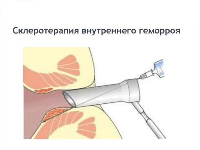 Склеротерапия внутренних геморроидальных узлов. Ультразвуковая склеротерапия геморроидальных узлов. Лигирование внутренних геморроидальных узлов. Лигирование склерозирование геморроя. Малоинвазивное лечение геморроя