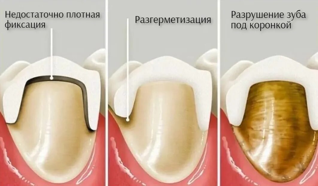 Почему пахнет между. Спиливание зубов под коронки.