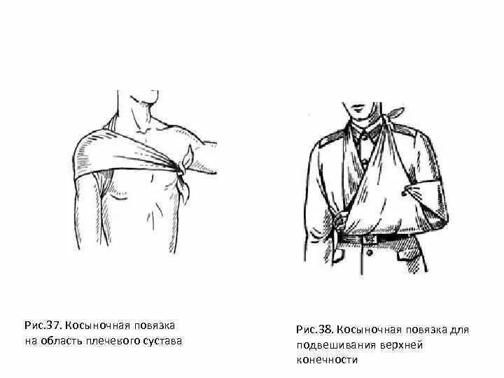 Косыночная повязка на плечо наложение. Косыночная повязка на плечо. Перелом плеча косыночная повязка. Перевязка косынка бинтом. Косыночная повязка на плечо.