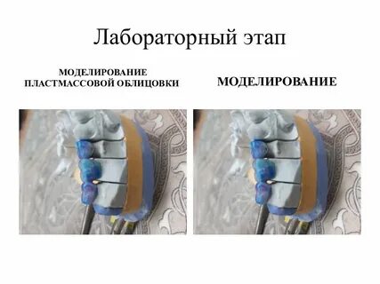 Клинико лабораторные этапы изготовления пластмассовых коронок