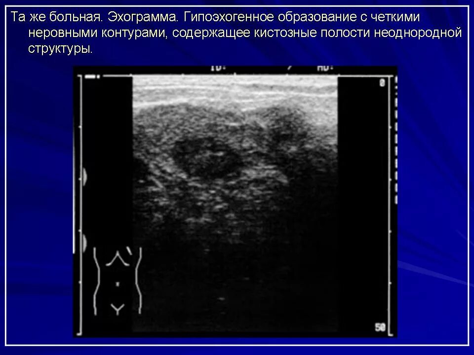 Гипоэхогенное округлое образование. Аваскулярное гипоэхогенное образование что это. УЗИ гипоэхогенное образование молочной железы. Филлоидная фиброаденома молочной железы УЗИ. Гипоэхогенные образования в молочной железе.