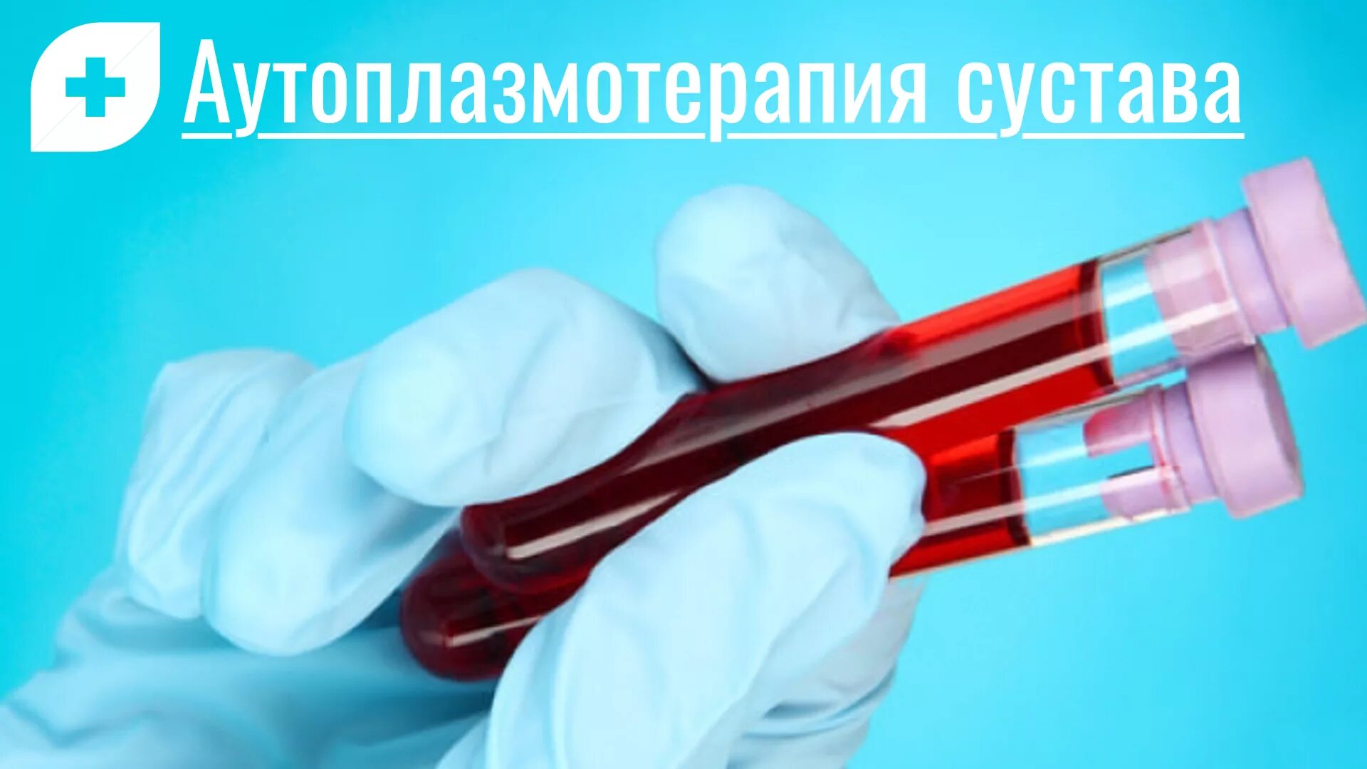 Плазмолифтинг суставов что это. PRP терапия Platelet Rich Plasma. Плазмотерапия суставов (PRP-терапия, плазмолифтинг). Плазмотерапия сустав PRP. Плазмолифтинг PRP терапия коленного сустава.