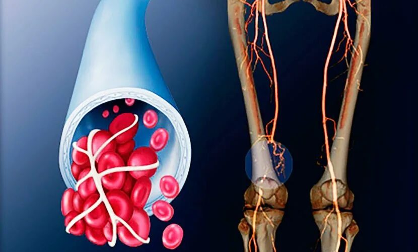 Тромб в сосудах нижних