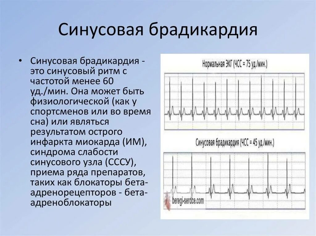 Пульс 52 у мужчины. Синусовая аритмия брадикардия. Синусовая брадикардия на ЭКГ. Синусовая аритмия на ЭКГ С ЧСС. Ритм синусовая брадикардия что это.