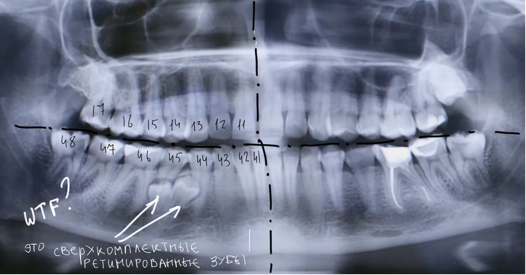 Аномалии удаления. Ортопантомограмма челюсти. Ортопантомограмма (ОПГ). Рентген сверхкомплект зубов.