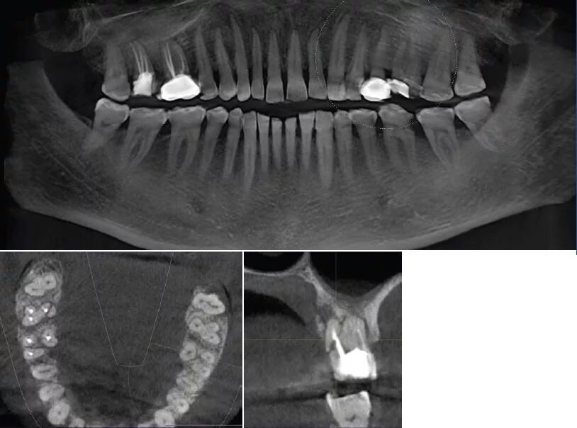 Где сделать кт зуба. КЛКТ зубов верхней челюсти. Кт челюсти (конусно-лучевая компьютерная томография).