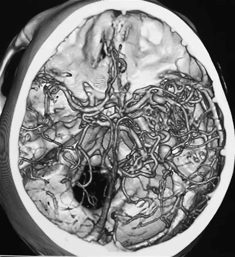 Сосудистая аномалия. Мальформация сосудов головного мозга. АВМ мальформация сосудов головного мозга. Артериовенозные мальформации сосудов головного мозга. Артериовенозная мальформация сосудов головного мозга мрт.