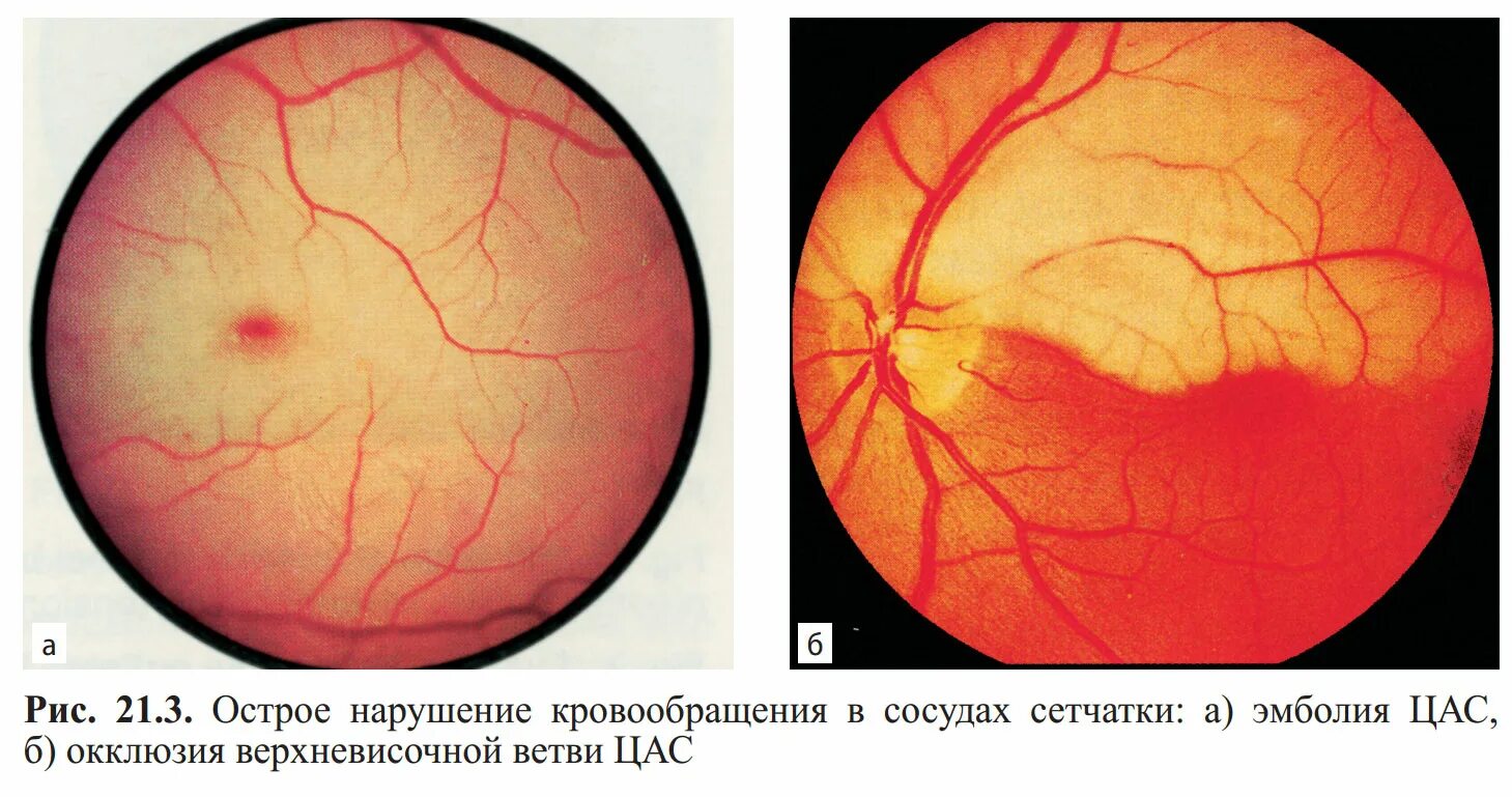 Нарушение кровообращения в сосудах. Тромбоз ЦВС глазное дно.