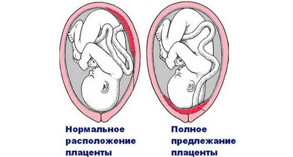 Низкая плацентация. Низкое расположение плаценты на 20 неделе. Низкое прикрепление плаценты 20 недель. Низкая плацентация 20 недель. При низкой плацентации можно