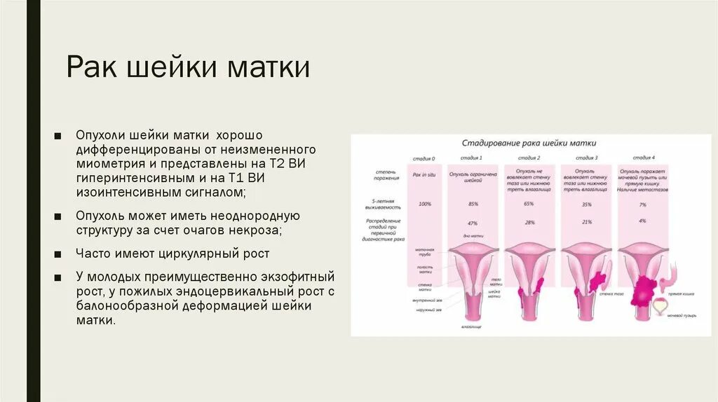 Код рак шейки матки. Онкология шейки матки 1 стадия. Локализация шейки матки. Степени онкологии шейки матки. Локализация опухолей шейки матки.