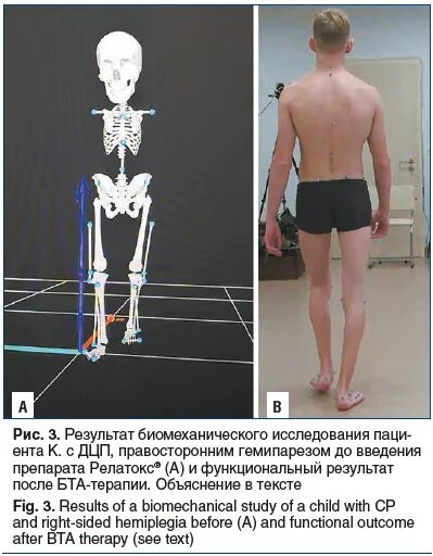 Правосторонний гемипарез. Гемипареза исследования. Гемипарез реабилитация