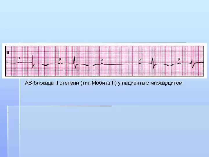 Атриовентрикулярная блокада 2. АВ блокада Мобитц 2 на ЭКГ. АВ-блокада 2 степени Мобитц 1 Тип 2:1. АВ блокада II степени Тип Мобитц II. Атриовентрикулярная блокада Мобитц 1.