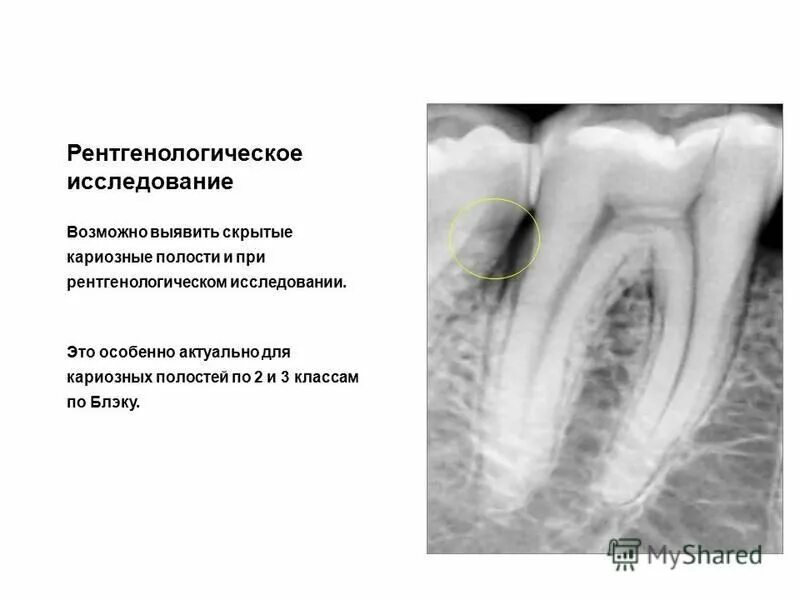 Кариозная полость сообщается с полостью зуба. Кариозная полость сообщается с полостью зуба
