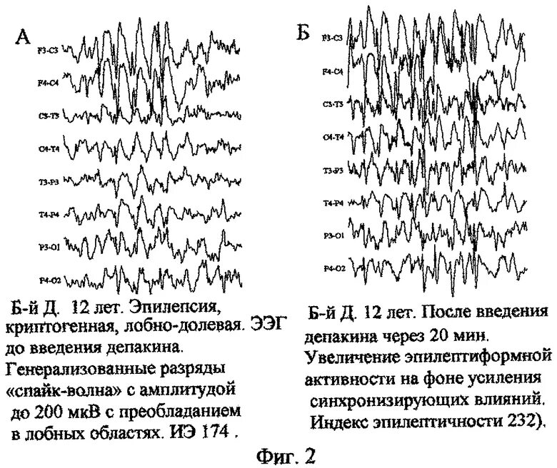 Запись на ээг. ЭЭГ эпилепсия расшифровка. ЭЭГ человека с эпилепсией. ЭЭГ головного мозга больного эпилепсией. ЭЭГ показатели больного эпилепсией.