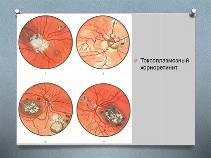 Токсоплазмоз глаз