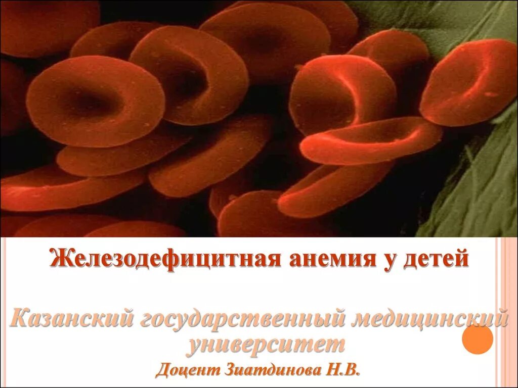 Железо дефицитная анемия. Железная дефицитная анемия. Анемия жда. Презентация на тему железодефицитная анемия. Презентация на тему жда у детей.