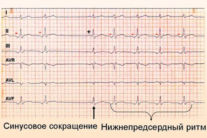 Ритм предсердий у ребенка. Эктопический ритм на экг. нижнепредсердный ритм на экг. эктопический правопредсердный ритм на экг. верхнепредсердный ритм на экг.