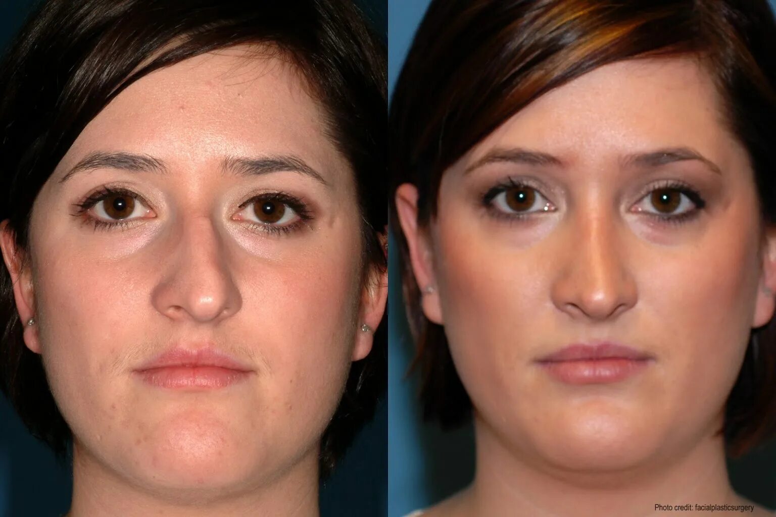 Искривленная перегородка носа. Асимметрия носа риносептопластика. Можно ли исправить носовую перегородку. Бродовский максим борисович септопластика. Искривление носовой перего.