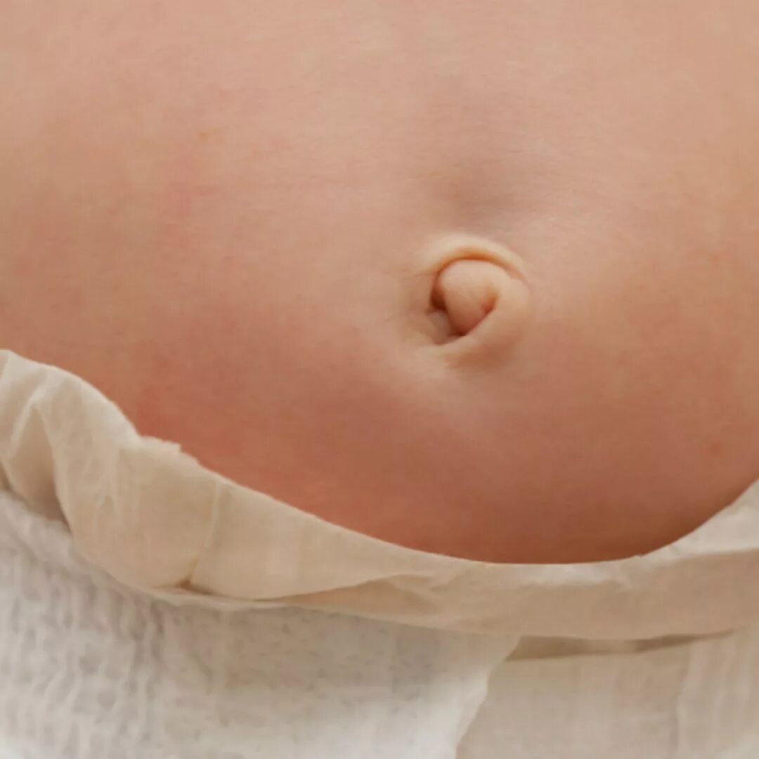 Покажите пуп. Пупочная грыжа новорожденного у грудничка. Омфалит новорожденных омфалит.