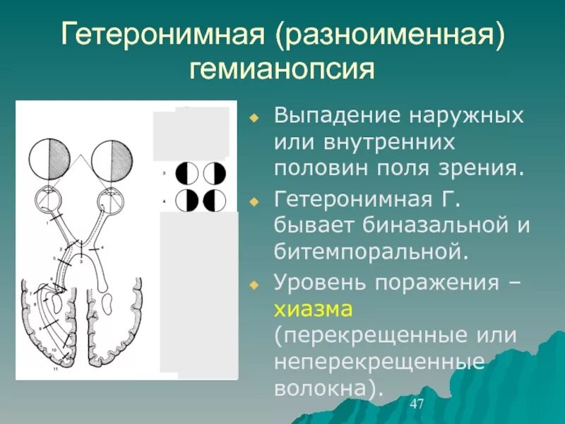 Битемпоральная гетеронимная гемианопсия. Биназальная гемианопсия. Правосторонняя гемианопсия очаг поражения. Правосторонняя верхнеквадрантная гемианопсия. Монимен