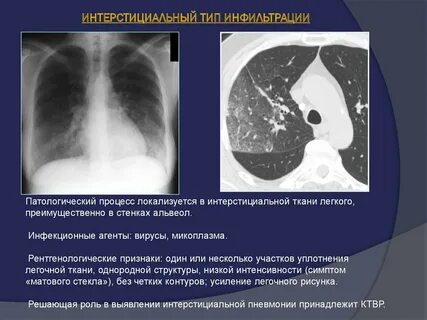 Типы инфильтрации легких