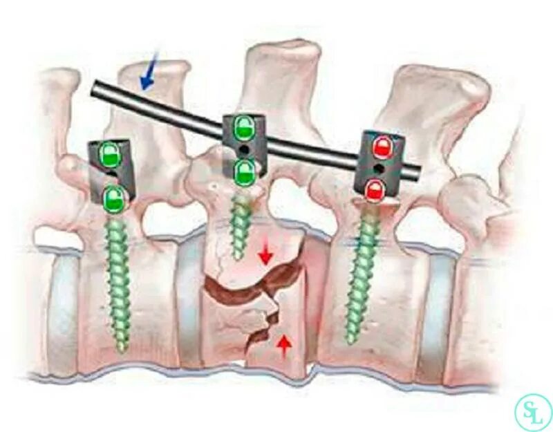 Транспедикулярная фиксация l1-l2-l3-l4-l5 системой. Транспедикулярная фиксация позвоночника l4-l5. Транспедикулярная фиксация l5-s1 позвонков. Транспедикулярная фиксация l3 l4. Операция на позвоночник как вставать