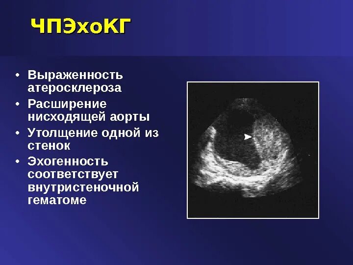 Атеросклероз на узи. Эхокг при аневризме аорты. расслаивающая аневризма на узи. расслоение аорты на эхокг. расслаивающая аневризма аорты эхокг.