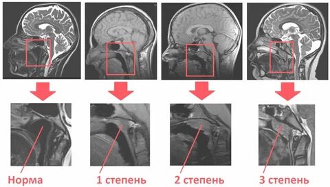 Степени аденоидита у детей