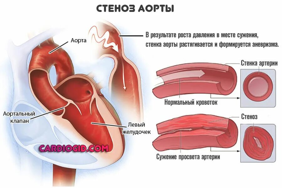 Аортальный стеноз что это такое. Стеноз аортального клапана. Пороки сердца аортальный стеноз и недостаточность. Стеноз отверстия аортального клапана. Стеноз двустворчатого аортального клапана.