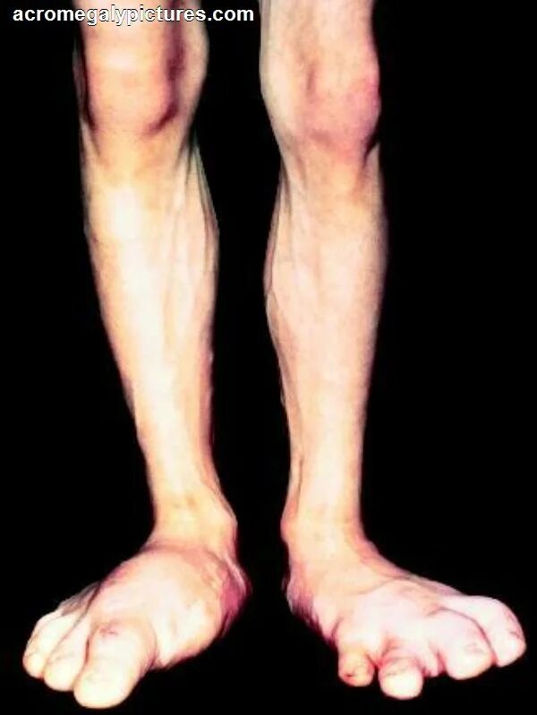 Гигантизм болезнь акромегалия. Гормоны щитовидной железы базедова болезнь. Избыыток соматоропного гомона. Гормон роста акромегалия. Акромегалия это заболевание.