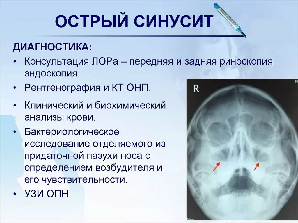 Острый фронтит острый синусит. Острый Гнойный верхнечелюстной синусит диагностика. Одонтогенный синусит верхнечелюстной пазухи. Острый катаральный синусит клиника. Гайморит симптомы чем лечить